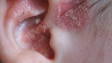 Rycina 3. Rozległe tarczki łuszczycowe w obrębie małżowiny usznej oraz w jej otoczeniu u 7-letniego chłopca.
