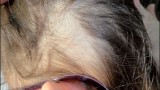 Ryc. 2. Trichotillomania. Nieregularnego kształtu ognisko pozbawione włosów w prawej okolicy skroniowej u 13-letniej dziewczyny.