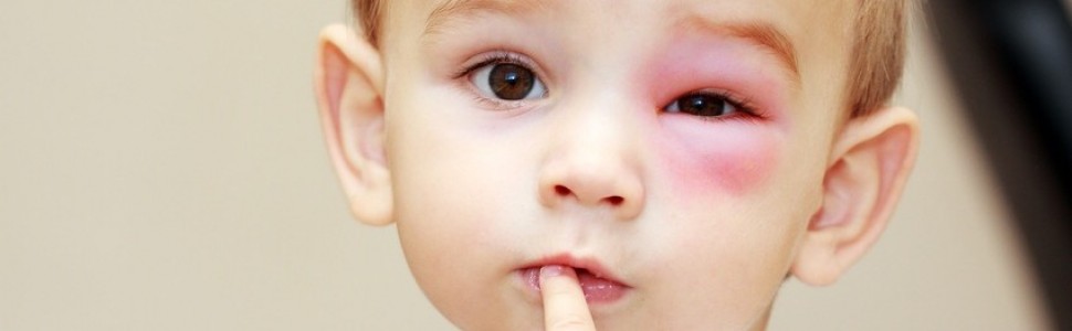 Ekspert: Choroby alergiczne są bagatelizowane, mimo że często zagrażają życiu
