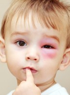 Ekspert: Choroby alergiczne są bagatelizowane, mimo że często zagrażają życiu